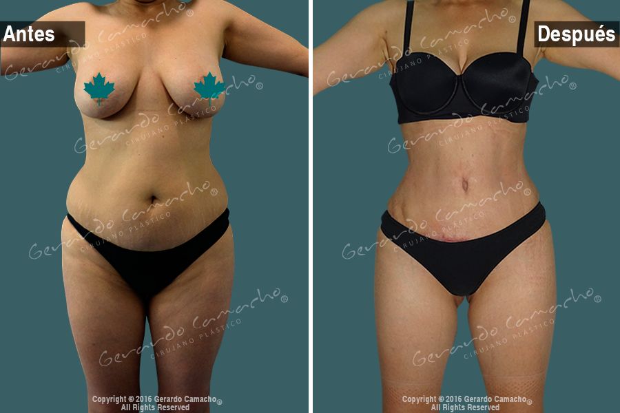 Figura remodelada con abdominoplastia en Bogotá